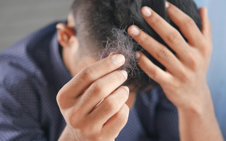 Wat kost een haartransplantatie